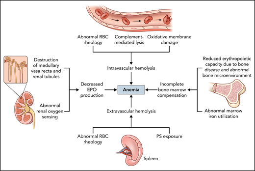 Factors contributing to anemia in SCD. The main mechanisms driving anemia in SCD include intravascular and extravascular hemolysis, decreased EPO production, and incomplete bone marrow compensation. Different mechanisms may predominate or act synergistically in different individuals with SCD, contributing to the phenotypic variability of the disease. Using a combination of targeted therapies to address more than 1 mechanism simultaneously may provide more effective and individualized approaches to treating anemia in SCD.