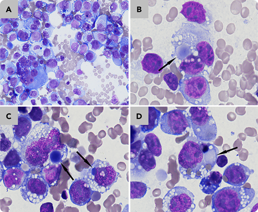 A 13-year-old boy with a history of left knee joint and back pain presented with severe discomfort, inguinal lymphadenopathy, thrombocytopenia, and anemia (white blood cell count 4.1 × 109/L, hemoglobin 9.4 g/dL, platelets 106 × 109/L). Magnetic resonance imaging revealed infiltrations in the extracranial soft tissue, mastoid, pleura, paralumbosacral soft tissue, testes, pelvic lymph nodes, and bone marrow. Peripheral blood film suggested normocytic anemia. Bone marrow aspirate analysis showed 78% uninucleated to binucleated to multinucleated large cells with basophilic cytoplasm and cytoplasmic vacuoles, sometimes adhesive and clustered (panel A; Wright-Giemsa stain, 40× objective; total magnification ×400); 5% of these cells contained paranuclear blue inclusions (panels B-D; Wright-Giemsa stain, 100× objective; total magnification ×1000). Needle biopsy of the patient’s swollen inguinal lymph nodes revealed rhabdomyosarcoma, with cells positive for vimentin, desmin, myogenin, and myoD1. The boy’s condition deteriorated rapidly, and he died on day 11 after admission.