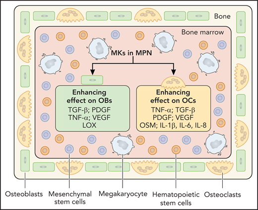 MPN MK-released factors affecting bone homeostasis. MK-released factors that enhance OB and/or OC development are depicted. Although not shown here, as noted in the text, depending on concentration, some factors can both enhance or inhibit the development of the same lineage, as in the case of the effect of TNF-α on OBs or TGF-β and IL-6 on OCs. Other factors have only a negative effect on function, such as the influence of IL-1β on OBs. Professional illustration by Patrick Lane, ScEYEnce Studios.