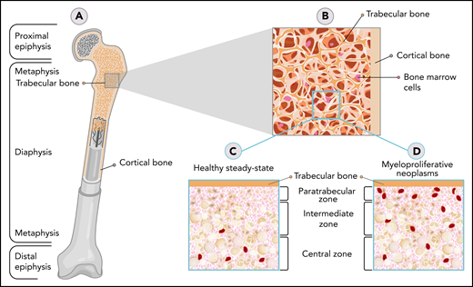 Atypical localization of MPN MKs close to bone areas. (A) A general structure of a long bone. (B) An enlarged area showing the cortical and trabecular bone. (C) An enlarged area depicting the organization of the bone marrow with its zones and the distribution of cells in healthy steady state. (D) An enlarged area depicting the organization of the bone marrow with its zones and the distribution of cells in MPNs. MKs are shown in red. The paratrabecular zone shown in panels C and D is adjacent to trabecular bone and normally has mostly myeloid precursor cells. The intermediate zone usually includes erythroid colonies and maturing myeloid cells. The central zone contains erythroid cells, maturing myeloid cells, sinusoids, and MKs. However, as cited in the text, MPNs are characterized by an increased number of MKs that tend to atypically localize closer to the paratrabecular zone and the endosteal border.