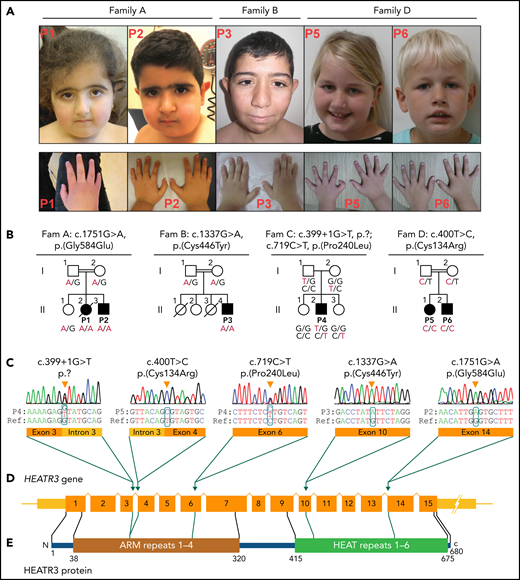 Clinical presentation and HEATR3 variants that drive DBA. (A) Photographs of the face and hands of the affected P1, P2, P3, P5, and P6 (photos from Family C not available). No common facial finding was present in affected individuals, but straight eyebrows, down-slanting palpebral fissures, and synophrys are apparent in some. Note that fingers in P1, P3, and P6 appear disproportionately short compared with the hand. Also note the presence of thumb anomaly in P5. (B) The pedigrees of Families A to D with genotypes for specified HEATR3 variants are indicated below each available individual. The pathogenic variants are indicated in red. (C) HEATR3 variants cosegregating with DBA in one affected individual from each family arranged according to position of coding sequence in ascending order. The missense variants c.400T>C (p.Cys134Arg) in P5, c.1337G>A (p.Cys446Tyr) in P3, and c.1751G>A (p.Gly584Glu) in P1 and P2 are homozygous; the splice donor site variant c.399 + 1G>T (p.?) and the missense variant c.719C>T (p.Pro240Leu) are compound heterozygous in P4. (D) Schematic representation of HEATR3 with 15 exons. (E) HEATR3 protein with four ARM (Armadillo) and six HEAT (Huntingtin, Elongation factor 3, protein phosphatase 2A, and Target of rapamycin 1) repeat domains, indicating the position of associated variants. The protein domains have been described previously.27,28