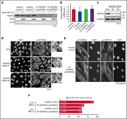 HEATR3 variants affect protein levels and uL18 nuclear localization. (A) Representative western blot of lysates from LCLs derived from P2 and P3 that were either untreated or exposed to the proteasome inhibitor MG-132. Specific antibodies are used to detect the relative amounts of HEATR3. Protein p53 provides a positive control showing proteasome inhibition by MG-132. Actin detection was used as loading control. (B) Real-time polymerase chain reaction analysis of complementary DNAs generated from LCLs derived from a healthy control or from P2 and P3 using primers to measure HEATR3 mRNA levels. The mRNAs of genes 36B4, ACTB, and GAPDH were used as references. Data shown are the results of 6 biological replicate experiments. (C) Western blot of lysates from HeLa cells transfected with 2 different siRNAs targeting HEATR3 (#1 and #2) or a control scrambled siRNA (SCR) probed with antibodies against HEATR3. Glyceraldehyde-3-phosphate dehydrogenase (GAPDH) detection was used as loading control. (D) Wide-field fluorescence microscopy of HeLa cells transfected with SCR or HEATR3 siRNAs and stained with 4′,6-diamidino-2-phenylindole (DAPI) (to label the nucleus) and antibodies against uL18, shown at ×20 magnification. The insets show enlarged pictures of the areas framed by dotted lines. The arrowheads point to stained nucleoli, which are observed in control cells but not after HEATR3 knockdown. (E) Fibroblasts derived from a healthy control or P2, stained with DAPI and antibodies against uL18 or uL5. Scale bar, 10 μm. (F) Quantification of the number of fibroblasts revealing nuclear staining of uL18.