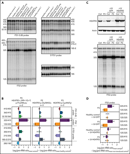 Variants in HEATR3 affect pre-rRNA processing. (A) Northern blot analysis of LCLs derived from control or affected individuals carrying HEATR3 variants. Radiolabeled probes targeting the 5′ extremity of internal transcribed spacer 1 (5′ITS1), the ITS1/5.8S junction (ITS1-5.8S), or internal transcribed spacer 2 (ITS2) were used to detect pre-rRNA precursors. Each lane was loaded with 3 µg total RNA. (B) Quantification of pre-rRNAs in LCLs derived from individuals carrying HEATR3 variants was performed by using Ratio Analysis of Multiple Precursors: product-to-precursor ratios at various processing steps are expressed as variations relative to LCLs from healthy controls. Mean values ± standard error of the mean from 3 independent experiments, aside from sample P4, for which n = 2. (C) Restoration of HEATR3 expression in LCLs from P3. LCLs from P3 and from a control individual were transduced with lentiviruses expressing either green fluorescent protein (LV-GFP) or HEATR3 (LV-HEATR3). Western blot analysis confirmed expression of HEATR3 in P3 LCLs transduced with LV-HEATR3 (upper panel). Northern blot analysis of total pre-rRNAs with probe ITS2 showed restoration of a normal pre-rRNA processing pattern. (D) Ratio Analysis of Multiple Precursors quantification of the northern blot shown in panel C. Product-to-precursor ratios in P3 LCLs at steps related to the processing of the large subunit rRNA precursors are expressed as variations relative to LCLs from the healthy control. Mean values ± standard error of the mean from 3 independent experiments.