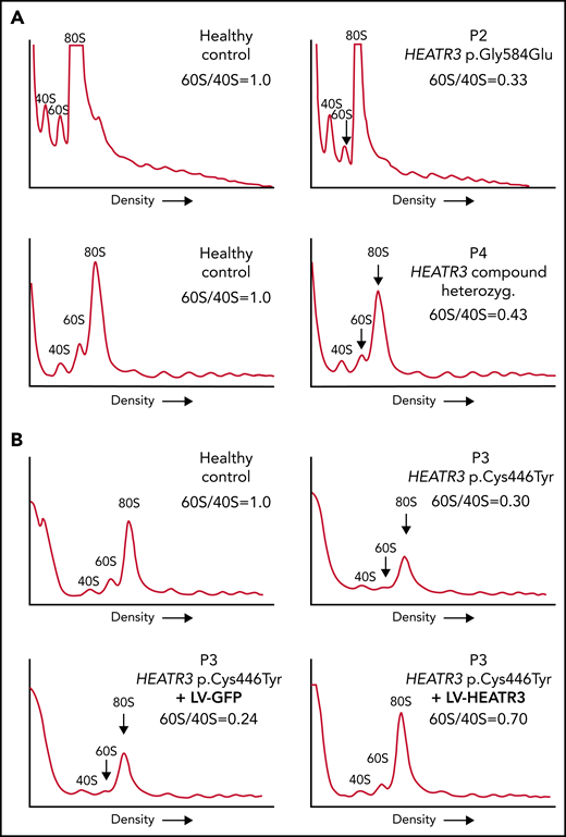 Variants in HEATR3 impair 60S ribosomal subunit accumulation. (A) Representative polysome profiles of lysates from LCLs derived from healthy individuals or patients (P2 and P4). The 40S subunit, 60S subunit, and 80S monosome are labeled. The vertical arrow highlights the reduction of 60S subunits in the samples from P2 and P4. (B) Representative polysome profiles of lysates from LCLs transduced with lentiviruses expressing HEATR3 or GFP complementary DNA. At least 3 independent experiments were performed with each cell line (panels A and B).