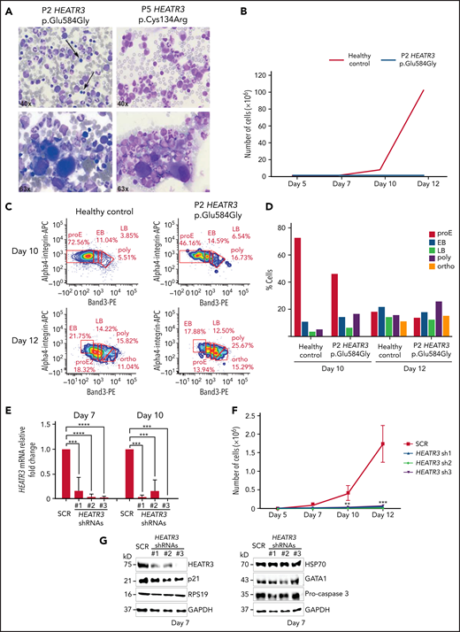 Erythroid cell proliferation and differentiation are impaired in individuals with HEATR3 variants. (A) Bone marrow aspirates of P2 (left panels) and P5 (right panels) with May-Grünwald-Giemsa staining, demonstrating a paucity (arrows) or absence (P5) of erythroid precursors and hypolobulated megakaryocytes (lower panels). (B) Cell count of purified CD34+ from the peripheral blood of P2 (orange line) and a healthy control (blue line) subject to the erythroid culture assay was performed (n = 1 to minimize invasiveness). Shown are cell counts on days 5, 7, 10, and 12. (C) Flow cytometry analysis of differentiating erythroid cells from P2 and a healthy control at days 10 and 12. (D) Quantification of panel C. (E) Reverse transcription quantitative real-time polymerase chain reaction quantification of HEATR3 transcript levels in CD34+ cells infected with lentiviral constructs expressing shRNAs targeting HEATR3 or a scrambled control (SCR). (F) Cell numbers on days 5, 7, 10, and 12 of an erythroid culture assay after infection with the lentiviral vectors expressing HEATR3 shRNAs. (G) Western blot analysis of the cells on day 7. Blots were probed with antibodies against HEATR3, p21, eS19 (RPS19), heat shock protein 70 (HSP70), GATA1, and pro-caspase 3. Glyceraldehyde-3-phosphate dehydrogenase (GAPDH) was used as loading control. APC, allophycocyanin; EB, early basophilic erythroblasts; LB, late basophilic erythroblasts; ortho, acidophilic erythroblasts; poly, polychromatophilic erythroblasts; proE, proerythroblasts. **P < 0.002; ***P < 0.001; ****P < 0.0001.
