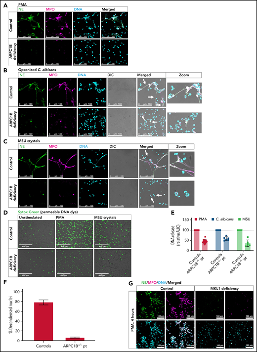 Patients with ARPC1B and MKL1 deficiency are impaired in NET formation. Representative images of PMA-induced (A), C. albicans–induced (B), and MSU crystal–induced (C) NETs by control and ARPC1B-deficient neutrophils visualized by staining for NE (green), MPO (magenta), and DNA (cyan; Hoechst). Arrows indicate NET structures around C. albicans hyphae and MSU crystals (control) or neutrophils adhered/engulfing C. albicans hyphae or MSU crystals (patient). Images were acquired by using a Leica SP8 confocal microscope. (D) DNA release induced by MSU crystals was visualized by Sytox Green. Images were acquired by an EVOS Fluorescence Cell imaging system. (E) DNA release was measured in real-time by Sytox Green–fluorescence for 4 hours at 37°C, and the area under the curve (AUC) was calculated relative to the relevant day control neutrophils (mean ± SD, n = 6-14). (F) Quantification of NETosis by control and ARPC1B-deficient neutrophils (n = 3) determined as relative number of decondensed nuclei after 4 hours activation with PMA. (G) PMA-induced NETs by control and MKL1-deficient neutrophils (n = 1). Bars represent 100 μm (A-C), 400 µm (D), and 100 µm (G). DIC, differential interference contrast.