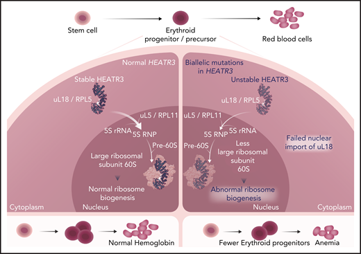 In normal bone marrow erythroid progenitors (left panel), HEATR3 acts as a shuttling factor that imports ribosomal protein uL18 from the cytoplasm to the nucleus. There, it associates with uL5 and the 5S ribosomal RNA (rRNA) to form the 5S ribonucleoprotein (RNP) complex, which is incorporated with maturing large ribosomal subunits to form the central protuberance. Intact ribosome biogenesis is a prerequisite for erythroid progenitor proliferation and differentiation to red blood cells. Biallelic HEATR3 variants destabilize the HEATR3 protein, reducing nuclear uL18 (right panel). HEATR3 variants cause pre-RNA processing defects, reduced 60S ribosomal subunits, and failure of erythropoiesis, presenting clinically as anemia. Professional illustration by Somersault18:24.