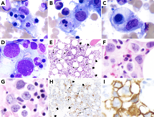 A 67-year-old woman presented with fatigue, fever (38.6°C), bicytopenia (platelets 9 × 103/µL; hemoglobin 9.6 g/dL), elevated ferritin (4313 ng/mL)/triglycerides (481 mg/dL)/interleukin-2 receptor (CD25: 87 950.0 pg/mL), cytomegalovirus viremia, and positive nasal swab for methicillin-resistant Staphylococcus aureus. A computed tomography scan showed hepatosplenomegaly without lymphadenopathy. Bone marrow aspirate smears showed hemophagocytic histiocytes (panels A-C: May-Grunwald-Giemsa, 100× objective, ×1000 magnification), large cells (panel D: May-Grunwald-Giemsa, 100× objective, ×1000 magnification), and negative flow cytometry. Trephine biopsy showed large cell infiltrate (panel E: hematoxylin and eosin (H&E), ×10X objective, 100× magnification; and panels F, G: H&E, 40× objective, ×400 magnification) with CD20 expression showing interstitial (not intravascular/intrasinusoidal) infiltration by lymphoma cells (arrows) and uninvolved sinusoids (arrowheads) (panel H: CD20, 10× objective, ×100 magnification showing interstitial distribution of large B cells; and panel I: CD20, 40× objective, ×400 magnification)/Bcl-2/Bcl-6/MUM1/MYC (not shown) and negative for CD10/CD5/cyclin-D1/CD30/ALK-1/TdT/CD34. Primary bone marrow diffuse large B-cell lymphoma (nongerminal center B cell) with hemophagocytic lymphohistiocytosis (HLH) was diagnosed (splenomegaly/fever/elevated ferritin/hypertriglyceridemia/elevated CD25/hemophagocytosis on aspirate met 6 of 8 criteria). Cytogenetics showed complex karyotype. After chemotherapy and antimicrobial coverage for methicillin-resistant S aureus and cytomegalovirus infections, the patient is doing well.