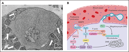 Intracellular mechanisms of proplatelet formation and elongation. (A) Transmission electron micrograph of a BM MK in contact with an endothelial cell. MK is outlined in black. Arrowspoint towards other BM cells interacting with the MK. Scale bar, 3 µm. (B) Platelet production from MKs is enabled through extensive cytoskeletal rearrangements leading to breaching of the endothelium through the formation of podosomes and proplatelet generation, during which proplatelets appear like “beads on a string” and function as essential intermediate structures. Initial polarization of the DMS is dependent on actin dynamics enabled by the Rho GTPase Cdc42, which induces LIMK1 activity and activates downstream effectors such as Cof1 and Twf1 and is further indispensable to enable proplatelet formation.81,82,99 In addition to Cdc42 and PDK1,102 activity of another Rho GTPase, RhoA, which induces MLC2/NMIIA activation,100,101 is critical in enabling F-actin rearrangements including the Arp2/3-dependent formation of podosomes, which are crucial to breach the endothelium, most likely though the secretion of MMPs.78,79 Proplatelet elongation on the other hand relies on microtubule sliding within the proplatelet shaft,117,127 which is dependent on the motor protein dynein.128 Cytoskeletal cross talk is enabled through proteins linking the F-actin to the microtubule cytoskeleton, such as EBs, APC, and mDia1.95,97