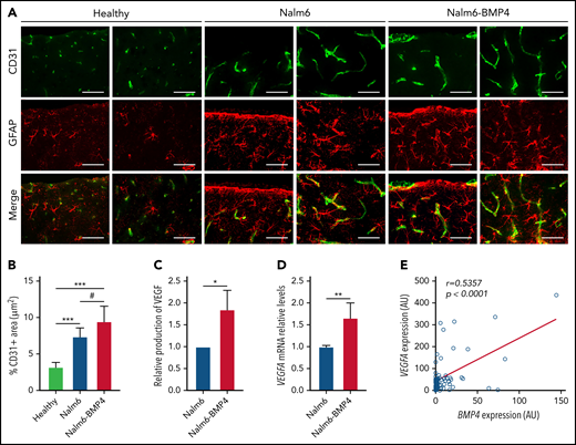High levels of BMP4 increase VEGF expression in leukemic cells and exacerbate angiogenesis in CNS of xenografted mice. (A) Representative images of CD31+ endothelial cells (green) and GFAP+ astrocytes (red) in sagittal brain cryosections of healthy, Nalm6, and Nalm6-BMP4 mice (Scale bars, 50 μm). (B) Quantitation of microvessel density using CD31 immunofluorescence. Three random cortical areas per section were imaged at magnification ×40. Fiji software was used for computerized quantification of immunostained vascular structures, and positive pixels were quantified and expressed as a percentage (±standard deviation) of CD31+ area per tissue total area (4 cryosections/3 mice per group; #P ≤ .05 and ***P ≤ .001; 2-tailed Student t test). (C) VEGFα production in Nalm6 and Naml6-BMP4 cell cultures (n = 4 independent experiments). Results are shown as increments relative to Nalm6 control cultures (*P ≤ .05; 2-tailed Mann-Whitney U test). (D) VEGFA mRNA expression in leukemic cells recovered from spleens of Nalm6 (n = 4) and Nalm6-BMP4 (n = 6) mice. Results are presented as increments relative to Nalm6 control cells (**P ≤ .01; 2-tailed Mann-Whitney U test). (E) Pearson’s correlation coefficient (r) and P value between VEGFA and BMP4 mRNA expression in primary BCP-ALL samples at diagnosis are shown (n = 57).