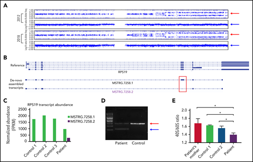 Molecular characterization and pathology of the patient’s novel RPS19 mutation. (A) The patient’s 2012 and 2018 chromosome 19 single nucleotide polymorphism genotype: the upper pattern is the B allele frequency and the lower pattern is the log R ratio. Red arrows indicate the B allele frequency splitting widening over time; blue arrows indicate no change in intensity of the total alleles. (B) Identification and visualization of RPS19 transcripts using the Integrative Genome Viewer. De novo transcript assembly identified 2 transcripts that mapped to the RPS19 gene locus (MSTRG.7258.1 and MSTRG.7258.2) and are shown below the reference RPS19 locus. Of note, although MSTRG.7258.1 resembles the reference transcripts, MSTRG.7258.2 lacks exon 4 (red box). (C) The normalized FPKM values of the indicated RPS19 transcripts are shown for all samples. MSTRG.7258.1, the WT transcript, was expressed in all samples, but MSTRG.7258.2 was expressed in the patient sample. (D) Patient and control complementary DNA transcripts were amplified using primers in exon 3 and exon 5 of the RPS19 gene. The red arrow indicates the WT transcript; the blue arrow the truncated transcript skipping exon 4 found in the patient but not control. Results were validated by Sanger sequencing. (E) 40s and 60s ribosomal subunit abundance determined by the areas under the peaks to calculate 40s/60s abundance ratios. Bars indicate standard deviation (n = 3). *P < .05. FPKM, fragments per kilobase per million.