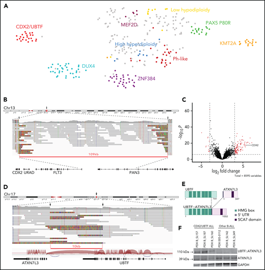 Identification of a novel gene expression B-ALL cluster characterized by CDX2 high expression and UBTF::ATX7NL3 fusion. (A) Gene expression profiling of 302 B-ALL cases shown in a 2-dimensional tSNE plot. This analysis was performed with 235 selected genes listed in supplemental Table 6. Major B-ALL subtypes are highlighted in different colors, and gray dots indicate other B-ALL. A novel cluster of cases with distinct gene expression profiling was identified, thereafter named CDX2/UBTF ALL. (B) WGS long-reads visualized on IGV software in 1 CDX2/UBTF case (B_SL160) showing a deletion at 13q12.2 locus close to the CDX2 gene. The red line underlines the deleted region. (C) Volcano plot of differentially expressed genes between CDX2/UBTF ALL (n = 23) and other B-ALL cases (n = 279). Genes with fold change greater than 3 and -log10 P value >7 are shown in red. CDX2 is highlighted as 1 of the 10 most highly expressed genes in the novel cluster. (D) WGS long-reads and RNA-seq splice junctions visualized on IGV software in 1 CDX2/UBTF case (B_SL160) showing a deletion at 17q21.31 locus involving the UBTF and ATXN7L3 genes. The red line underlines the deleted region. (E) Scheme of the predicted UBTF::ATXN7L3 chimeric protein. The resulting in-frame fusion transcript incorporated 60 nucleotides upstream the canonical translation start codon of ATXN7L3. (F) Western-blot of CDX2/UBTF cases using ATXN7L3 antibody shows detection of normal ATXN7L3 protein (39 kDa) in all samples and another protein at a size corresponding to the predicted UBTF::ATXN7L3 chimeric protein (110 kDa) in CDX2/UBTF cases only. Western blot performed on PDX from 3 CDX2/UBTF cases (B_SL157, B_SL187, and B_SL160), 2 PAX5 P80R cases (005-0112 and B_SL142), and 1 KMT2A-r case (B_SL349). IGV, integrative genomics viewer; PDX, patient-derived xenograft; tSNE, t-distributed stochastic neighbor embedding; WGS, whole-genome sequencing.