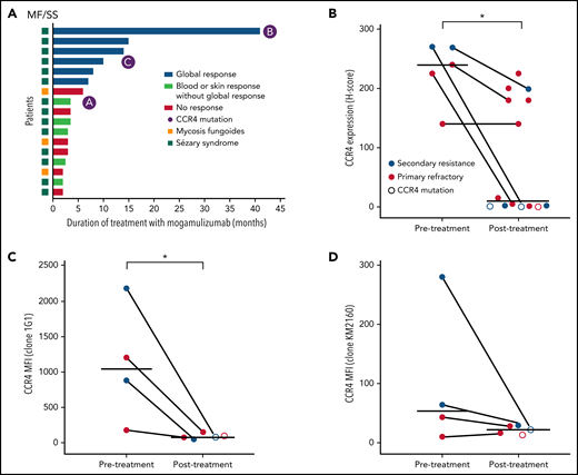 CCR4 expression decreases in a subset of patients after mogamulizumab treatment. (A) Total duration of treatment with mogamulizumab and best treatment responses. (B) CCR4 IHC expression pre- and posttreatment with mogamulizumab. Bars indicate mean H score. Lines connect paired samples from the same patient. (C-D) MFI of CCR4 by flow cytometry before and after treatment using 2 CCR4 antibodies: 1G1 (C) and KM2160 (D). *P < .05 by Mann-Whitney U test. H score, percentage of the CCR4+ cells among all cells in the infiltrate x intensity of expression 0-3+.
