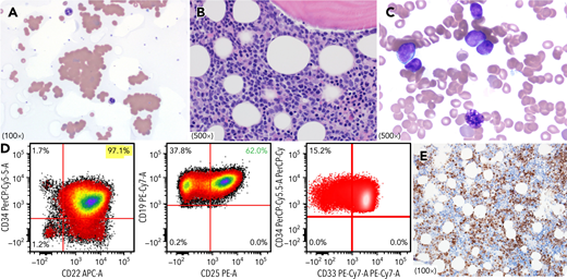 A 44-year-old man presented to emergency department with sudden-onset dyspnea and fatigue. Complete blood count showed marked normocytic anemia (hemoglobin, 6.8 g/dL) with normal white blood cell and platelet counts. Peripheral blood smear showed marked red cell agglutination (Wright-Giemsa stain, panel A). Further work-up demonstrated cold autoimmune hemolytic anemia (cAIHA) with increased serum lactate dehydrogenase (653 U/L; range, 135-225), mild hyperbilirubinemia (total 2.6 mg/dL; indirect, 1.4), decreased haptoglobin (<3 mg/dL; range, 32-197), positive direct antiglobulin test for C3d only, and a cold agglutinin titer of 128. Bone marrow biopsy showed unexpected B-lymphoblastic leukemia (B-ALL) in a 70% cellular bone marrow with 40% blasts (panel B, hematoxylin and eosin stain; and panel C, May-Grunwald-Giemsa stain). Flow cytometry immunophenotyping identified aberrant B-lymphoblasts (36%) with CD10bright+CD19+CD22+CD25partial+CD33 partial+CD34+ CD79a+ and negative for CD3, CD20, MPO, and CRLF2 (panel D). Blasts were positive for terminal deoxynucleotidyl transferase (TdT) immunostain (panel E). The patient was initially treated with steroids and rituximab for cAIHA followed by hyper CVAD (cyclophosphamide, vincristine, doxorubicin, dexamethasone), and blinatumomab for B-ALL.