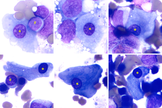 A 14-year-old Somalian male presented with mild-moderate leukopenia/neutropenia, mild macrocytic anemia, and severe thrombocytopenia (platelet count, 20 000-40 000/µL) since he was 6 years old. He had short stature, microcephaly, café au lait macules on the back, mild splenomegaly, and small testicles. Bone marrow biopsies showed variable hypocellularity (0%-40%) with markedly decreased megakaryocytes. Marrow aspirates showed few dysplastic megakaryocytes with abundant pale cytoplasm and small round nuclei (Jenner-Giemsa stain; 100× objective; original magnification, ×1000; *), similar to those of mature lymphocytes (#), compatible with micro-megakaryocytes, likely because of lack of endoreduplication. Chromosome breakage study, performed with peripheral blood and cultured fibroblasts, was normal, which did not support the diagnosis of Fanconi anemia. Telomere length was markedly decreased in peripheral blood lymphocytes and granulocytes, supporting a diagnosis of dyskeratosis congenita.