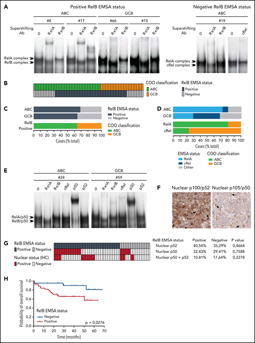Activation of RelB is frequent in patients with de novo DLBCL irrespectively of their ABC or GCB subtype and is associated with worse overall survival. (A) Whole cell extracts from frozen samples of 66 cases of de novo DLBCL (from the LYSA LNH03 trial) were analyzed by using EMSA for alternative RelB NF-κB subunit DNA-binding activity. Four representative RelB- positive cases (2 ABC and 2 GCB) and one RelB-negative case are presented. For supershifts, extracts were incubated with either anti-RelB or anti-RelA antibodies before incubation with the labeled probe. RelA- and RelB-containing complexes are indicated. (B) Distribution of RelB DNA- binding activity as defined by EMSA among the GCB and ABC patients with DLBCL (n = 66). (C) Top: prevalence of RelB activation as defined by EMSA in ABC and GCB DLBCLs (n = 66). Bottom: prevalence of ABC and GCB DLBCLs within the positive RelB-binding activity subgroup. (D) Top: prevalence of dominant activation of the 2 canonical NF-κB subunits RelA and cRel as defined by EMSA in ABC and GCB DLBCLs (n = 66). Bottom: prevalence of ABC and GCB DLBCLs within the 2 dominant canonical NF-κB subunit RelA and cRel activation subgroups. (E) Subunit composition of the RelA- and RelB-containing complexes as determined by supershift analysis with the indicated antibodies. (F) Immunohistologic staining of DLBCL biopsy specimens with anti–NF-κB2/p52 and anti–NF-κB1/p50 antibodies, n = 54 of the 66 EMSA cases. A representative image showing nuclear localization of NF-κB2/p52 (top left) and NF-κB1/p50 (top right) is presented. Magnification, ×200. The cutoff used to score cases as nuclear positive for p52 and p50 was ≥30%. (G) Correlation analysis of RelB DNA-binding activity with nuclear p52 and p50 as evaluated in panel F; n = 54 patients. P value by Fisher’s exact test. Color codes indicate the presence or absence of the corresponding feature. (H) Kaplan-Meier plot of overall survival according to RelB DNA-binding status (LYSA LNH03 trial, EMSA cases, n = 66). P value by log-rank (Mantel-Cox) test. IHC, immunohistochemistry.
