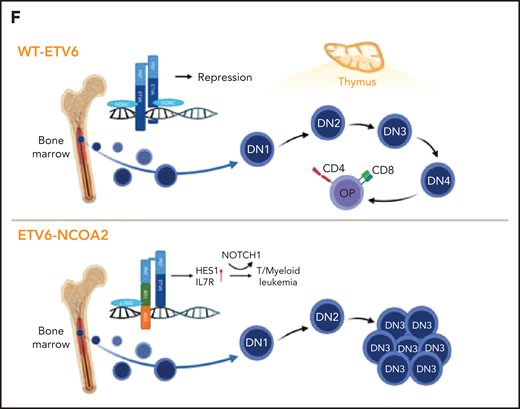 ETV6-NCOA2 causes de-repression of ETV6 targets. (A) Transcription factor binding site analysis (i-Cis target37). The analysis was performed separately for the significantly upregulated and downregulated differentially expressed genes of the bulk RNA-seq of CD34+ cells transduced with EN2 or empty vector, and for the in vivo EN2 engrafted cells, in vivo EN2 + NOTCH1-L1601PdP leukemia, and EN2 PDX samples. (B) GSEA analysis of EN2 in vitro and EN2 PDX sample pre-ranked RNA-seq results compared with the 500 top upregulated genes in the LOUCY cell line treated with short interfering RNA (siRNA) against ETV6 (siETV6).14 (C) ChIP-seq for H3K27Ac was performed on CD34+ cells transduced with EN2 or empty vector in vitro, and EN2 PDX. H3K27 differential acetylation of HES1 and DLL4 was examined by integrative genomics viewer63 analysis. (D) Left: Co-IP EN2/ETV6: HEK-293T cells were transfected with empty vector, EN2-Flag, ETV6-HA, or a combination of both. The proteins were immunoprecipitated with either Flag antibody (EN2) or HA antibody (ETV6). Right: Co-IP EN2/p300: EN2-Flag or ETV6-Flag stable DND41 cells were immunoprecipitated with either Flag antibody (top) or endogenous p300 antibody (bottom). (E) Left: 293T cells stably expressing ETV6 luciferase reporter vector were transfected with 200 ng ETV6 alone, increasing concentrations of EN2 (200, 300, and 400 ng) or a combination of both (ANOVA test P < .0001) (n = 6). Right: ETV6-luciferase reporter stable transfected 293T cells were transfected with 200 ng ETV6 alone or with 200 ng ETV6 with 1 of the following: EN2 200 ng, EN2 + 1 200 ng, or 5 μM A485 (a p300 inhibitor)51 or EN2 EN2 200 ng in addition to 1 or 5 μM A485 or A486 (inactive A485 analog) (ANOVA test P < .0001). (F) A scheme for proposed EN2 mechanism of leukemogenesis. Upper panel: ETV6-HDAC repression of genes in wt hematopoietic progenitors. Lower panel: EN2-ETV6-p300 complex in EN2 hematopoietic progenitors. This figure was created with BioRender.com. **P < .008; ***P < .0006; ****P < .0001. Chr, chromosome; HDAC, histone deacetylase.