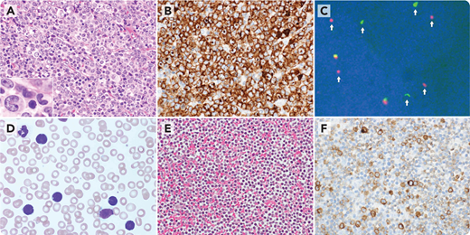 A 58-year-old woman presented with generalized lymphadenopathy. The lymph node showed diffuse involvement of atypical lymphoid cells, including hallmark cells (panel A, hematoxylin and eosin, 40× objective, ×400 original magnification) that were homogenously positive for CD30 (panel B, 40× objective, ×400 original magnification) and CD3, and negative for CD4, CD5, CD7, CD8, CD15, CD20, ALK, TIA-1, and granzyme B. Fluorescence in situ hybridization identified the rearrangement of DUSP22 (panel C, arrow, 100× objective, ×1000 original magnification), diagnostic of anaplastic large cell lymphoma (ALCL), ALK-negative. Five months after complete remission was achieved with chemotherapy, the leukocyte count in the peripheral blood increased to 196 × 109/L, primarily composed of small to medium-sized lymphoid cells (panel D, 100× objective, ×1000 original magnification). Similar cells in a bone marrow aspiration clot (panel E, 40× objective, ×400 original magnification) showed variable positivity for CD30 (panel F, ×40 objective, ×400 total magnification), indicative of small-cell pattern of ALCL. These cells exhibited DUSP22 rearrangement and an identical TRG rearrangement with the primary lymph node lesion.