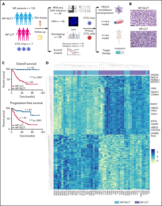 Characteristic transcriptional profiles and enriched gene expression at 7q in MF-LCT. (A) Flowchart depicting the overall clinical samples and experimental design of this study. (B) Histopathological features of biopsied specimens from a tumor-stage MF-LCT and MF-NLCT patient. Hematoxylin and eosin staining. Original magnification ×400. Scale bar = 25 μm. (C) Kaplan-Meier survival analysis of OS and PFS from advanced-stage MF patients classified into MF-LCT and MF-NLCT group. *P < .0001, n = 85. (D) Heatmap of 26 MF-LCT and 23 MF-NLCT samples stratified by top 200 DEGs between MF-LCT and MF-NLCT group. (E) Representative enriched molecular pathways in MF-LCT group via GSEA of 49-patient transcriptional profiles (FDR q-value <0.25, Norminal P < .05). (F) GSEA enrichment plot for romidepsin-resistance gene signature, which consists of upregulated genes in romidepsin-resistant versus romidepsin-sensitive CTCL cases from GSE132053. (G) Heatmap of CNV events identified from InferCNV analysis of 49-patient RNA-seq data and chr7 locus marked with red frame. (H) Enriched positional gene sets in MF-LCT group ranked by normalized enrichment score (FDR q-value <0.25, nominal P < .05). Gene sets at regions of chr7 marked with red color.