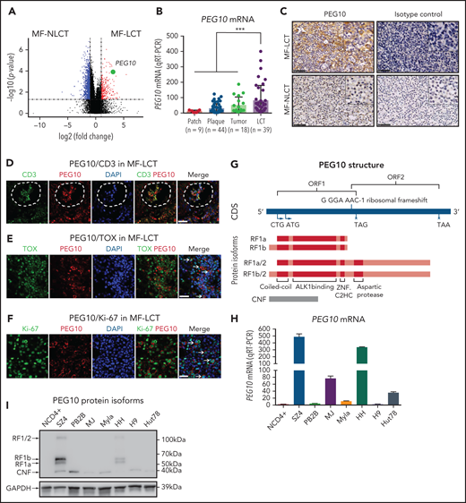 Expression and prognosis analysis of PEG10 in MF. (A) Volcano plot of upregulated (red) and downregulated (blue) DEGs (fold change ≥2 or ≤−2 and P <.05) between MF-LCT and MF-NLCT group and PEG10 gene pointed out in green color. (B) PEG10 mRNA expression in lesion-biopsied samples with different T stages of MF and MF-LCT. *P < .001, n = 110. qRT-PCR, real-time quantitative reverse transcription PCR. (C) Representative immuno-histochemical evaluation of PEG10 on lesion-biopsied samples from MF-LCT and MF-NLCT patients, IgG isotype controls serve as negative controls. Original magnification ×200, insets ×400, scale bar = 50 μm. (D) Immunofluorescence (IF) costaining of PEG10 (red) and CD3 (green) on a lesional biopsy specimen of tumor-stage MF-LCT. Pautrier’s microabscess pointed out with a dashed line circle. (E,F) IF costaining of PEG10 (red) and TOX (green). (E) PEG10 (red) and Ki-67 (green). (F) On lesional biopsy specimens of tumor-stage MF-LCT. DAPI (blue) used to visualize cell nuclei. Original magnification x400, scale bar = 25 μm. (G) The structure of PEG10 coding sequence (CDS) and protein isoforms. (H,I) PEG10 mRNA (H) and protein (I) expression levels among 7 CTCL lines and CD4+ T cells from normal controls (NCD4+). (J) OS and PFS of MF patients stratified by PEG10 expression from a discovery cohort of 49 RNA-seq samples and validation cohort of extended 70 MF samples via Kaplan-Meier survival analysis. (K) TTNT for HDACis in PEG10-low and PEG10-high patients via Kaplan–Meier analysis (n = 21 treatment episodes). **P < .05; ***P < .01.