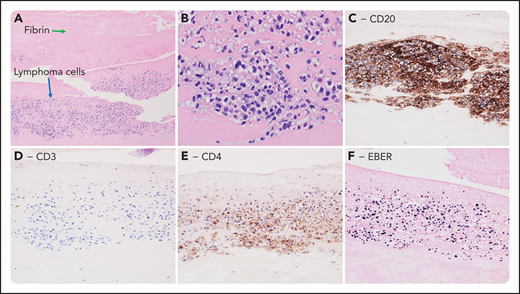 A 63-year-old woman with a long-standing history of pancreatic pseudocyst underwent resection due to worsening symptoms. Microscopic examination of the pseudocyst incidentally revealed a few aggregates of large cells within the fibrin surrounding the cyst wall (panel A; 10× objective, total magnification ×100; panel B; 40× objective, total magnification ×400; Hematoxylin and Eosin stain). By immunohistochemistry, these cells were positive for CD45, CD20 (panel C), CD4 (panel E), PAX5, MUM-1, and EBER (panel F), whereas they were negative for CD3 (panel D), CD10, BCL-6, CD30, HHV8, AE1/AE3, S100, synaptophysin, and MART1 (panels C-F; 20× objective, total magnification ×200). The CD4 positivity prompted additional workup to exclude T-cell lymphoma, blastic plasmacytoid dendritic cell neoplasm (BPDCN), myeloid sarcoma with monocytic differentiation, and an HHV8+plasmablastic neoplasm with aberrant T-antigen expression. The cells were negative for all other T-cell markers (CD3, CD2, CD5, CD7, CD25), BPDCN markers (CD56, CD123, TCL-1), myeloid markers (CD117, CD34, MPO, CD68, CD43), and HHV8. Hence, a diagnosis of fibrin-associated diffuse large B-cell lymphoma (FA-DLBCL) with aberrant CD4 expression was made.
