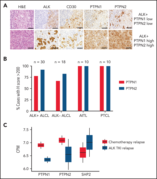 Patient samples resistant to ALK TKI show downregulation of PTPN1 and PTPN2 and upregulation of SHP2. (A) Representative hematoxylin-eosin and immunohistochemistry stainings of ALK, CD30, PTPN1, and PTPN2 in 1 ALK+ case expressing low PTPN1 and low PTPN2 (top) and 1 ALK+ ALCL case expressing high PTPN1 and high PTPN2 (bottom). Tumor cells are identified by ALK and CD30 stainings. High expression was determined by an H score >200. Scale bar, 100 μm. (B) Percentage of cases with high PTPN1 or PTPN2 protein expression of PTPN1 and PTPN2 evaluated by immunohistochemistry in human T-cell lymphoma subtypes: ALK+ ALCL (n = 30), ALK− ALCL (n = 18), AITL (n = 10), and peripheral T-cell lymphoma (n = 10). High expression was determined by an H score >200. (C) RNA-seq data from chemotherapy-relapsed/refractory (n = 2) and ALK TKI–resistant (n = 2) patients to evaluate mRNA expression of PTPN1, PTPN2, and PTPN11 (SHP2). ALK mutation status was analyzed by sequencing following a biopsy of relapsed lymphoma samples. The 2 patients that relapsed after chemotherapy showed WT ALK. Of the 2 patients relapsed during ALK TKI, 1 patient was WT, and 1 patient carried the L1196M mutation in ALK. See supplemental Figure 12 for treatment details. CPM, counts per million.