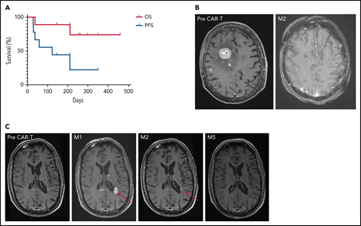 Survival and imaging of patients with R/R PCNSL treated with commercial anti-CD19 CAR T-cells. (A) OS and PFS. Median OS was not reached. Median PFS was 122 days for the whole cohort, increasing to 210 days for responders, vs 29 days for non-responders. (B) Patient 3: right frontal lesion at baseline and CR 2 months after CAR T-cell infusion. (C) Illustration of the flare effect suspected in patient 6: appearance of a left periventricular lesion 1 month after CAR T-cell infusion that dramatically decreased 2 and 5 months later. Despite high suspicion of a flare effect, response was reported as progressive disease according to the IPCG criteria, thus potentially underestimating PFS.