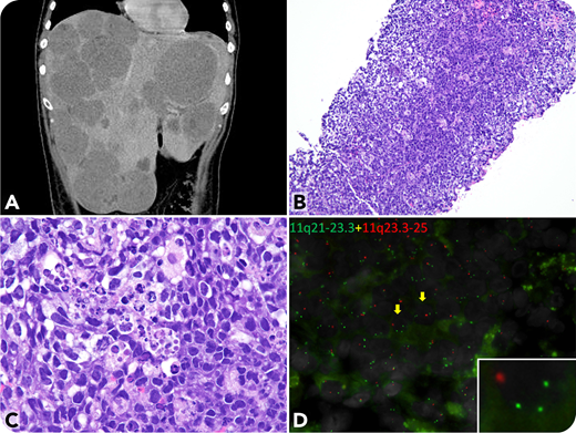 A 40-year-old White man presented after having 3 months of dull epigastric pain and a weight loss of 13 kg. A computed tomography scan of the abdomen showed multiple hepatosplenic tumors (panel A) and peripancreatic lymphadenopathy. A liver biopsy showed a diffuse infiltrate of lymphoma cells with focal starry-sky appearance (panel B; original magnification ×40). The cells were medium size and possessed a thin rim of cytoplasm and round or oval nuclei with coarse chromatin and inconspicuous nucleoli (panel C; original magnification ×100). Notable were prominent (5-9) phagocytosed apoptotic bodies and coarse apoptotic debris in macrophages. The neoplasm had a Burkitt-like immunophenotype (CD20+/CD10+/BCL6+/MUM1–/BCL2–/Ki-67high). Fluorescence in situ hybridization analysis showed gains of ARHGAP42 on 11q22.1 (panel D; green signals; original magnification ×40; inset, ×100) and loss of FLI1 on 11q24.3 (panel D; red signals; yellow arrows), There was no evidence of MYC translocations. The patient was treated with 4 courses of a rituximab plus cyclophosphamide, vincristine, doxorubicin, and dexamethasone (R-Hyper-CVAD) regimen, and an imaging study revealed interval regression.