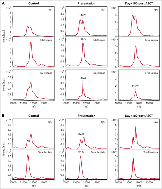 Paraproteins are detectable by MALDI-TOF MS in the sera of the majority of patients with NSMM and the unique m/z can be used to track the paraprotein through treatment. (A) A 0.086 g/L IgA κ paraprotein that was detectable in the presentation sample of a patient with NSMM (immunofixation negative, IgG 7.31 g/L, IgA 4.1 g/L, IgM 0.8 g/L, serum free κ 79.4 mg/L, serum free λ 22.7 mg/L, sFLCr 3.50) at m/z 11 670 and monoclonal κ FLC were detectable at m/z 11 669 for the doubly charged light chains, respectively. At day+100 after ASCT, the sFLCr had normalized (serum free κ 22.7 mg/L, serum free λ 14.12 mg/L, sFLCr 1.60) but MS detected residual monoclonal κ FLC with the same m/z as detected in the baseline sample. (B) A 0.14 g/L IgG λ monoclonal protein detectable by MS at m/z 11 432 for the doubly charged light chain in the presentation sample from a patient with NSMM (immunofixation negative, IgG 5.40 g/L, IgA 0.5 g/L, IgM 0.39 g/L, serum free κ 5.46 mg/L, serum free λ 6.08 mg/L, sFLCr 0.90). At day+100 after ASCT oligoclonal peaks are present in the IgG and λ spectra but no residual monoclonal protein is detectable at m/z 11 432.