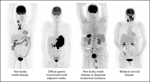 The many faces of limited-stage DLBCL.