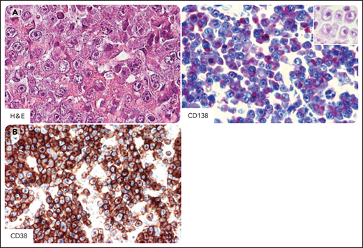 DLBCL in individuals infected by HIV. Systemic DLBCL with immunoblastic-plasmacytoid features, expressing the CD20+, CD10−, BCL6−, MUM1/IRF4+, CD138+, and CD38+ profile. (A) Hematoxylin-eosin stain (H&E) shows that most tumor cells display large cytoplasms and round or oval nuclei with large nucleoli. Tumor cells express cytoplasmic staining for CD138 (red). The H&E stain (inset) shows that the morphology of immunostained cells is immunoblastic. (B) Tumor cells express cytoplasmic and membranous staining for CD38 (brown). CD138 and CD38 immunohistochemistry, hematoxylin counterstain. Original magnification, ×400. Images were taken using a Nikon Eclipse 80i microscope with a Plan Fluor 40×/0.75 objective and Nikon digital sight DS-Fi1 camera equipped with control unit-DS-L2. Images were processed using Adobe Photoshop CS2 V9.0.