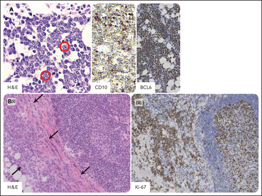 Burkitt lymphoma in individuals infected by HIV. Burkitt lymphoma with plasmacytoid differentiation; phenotypically, the tumor cells express B-cell antigens including CD20, CD10, and BCL6 and are consistently negative for BCL2. The proliferation index is very high, approximately 100%. (A) A homogeneous proliferation of medium-sized tumor cells displays a cohesive pattern. Tumor cells show round nuclei, multiple nucleoli, and small basophylic cytoplasm. Immunoblastic-like tumor cells (in the red circle) with larger nucleoli are also seen. Tumor cells typically express CD10 with membranous staining pattern and BCL6 with nuclear staining pattern. (B) Burkitt lymphoma involving capsular and extranodal tissues (arrows; i) and a hyperplastic lymphoid follicle within a reactive hyperplastic lymph node (ii). The extranodal pattern of tumor infiltration is confirmed by Ki-67 staining. H&E, hematoxylin-eosin stain; CD10, BCL6, and Ki-67 immunohistochemistry, hematoxylin counterstain. Original magnification, ×200. Images were taken using a Nikon Eclipse 80i microscope with a Plan Fluor 20×/0.75 objective and Nikon digital sight DS-Fi1 camera equipped with control unit-DS-L2. Images were processed using Adobe Photoshop CS2 V9.0.