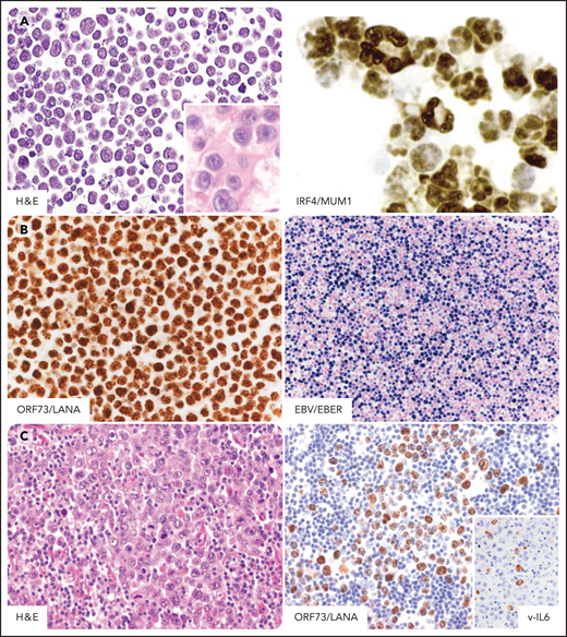 PEL in individuals infected by HIV. PEL cells express markers associated with plasma cell differentiation such as CD138, CD38, and MUM1/IRF4. Tumor cells are usually negative for B-cell and T-cell markers (data not shown). (A) In a cell line derived from a classic PEL, tumor cells display features bridging immunoblastic and anaplastic large cell lymphomas and morphologically show a certain degree of plasma cell differentiation. (Inset) In a cell block derived from a primary classic PEL tumor cell are features resembling immunoblastic lymphoma cells. Plasma cell differentiation is confirmed by nuclear immunohistochemical staining for IRF4/MUM1. (B) Immunohistochemical staining for ORF73/LANA detects evidence of KSHV infection. Typically, the staining pattern is speckled. EBER in situ hybridization detects Epstein-Barr virus in tumor cells. The positive nuclei are stained in blue. (C) In a case of extracavitary solid PEL, tumor cells show morphologic features similar to those seen in serous effusion of classic PEL. Immunohistochemical staining for ORF73/LANA is the standard assay to detect evidence of KSHV infection also in tumor tissue. (Inset) Fraction of tumor cells expresses KSHV viral IL6. H&E, hematoxylin-eosin stain; MUM1, ORF73/LANA, v-IL6, immunohistochemistry, hematoxylin counterstain; EBER, in situ hybridization, nuclear fast red counterstaining. Original magnification ×400. Images were taken using a Nikon Eclipse 80i microscope with a Plan Fluor 40×/0.75 objective and Nikon digital sight DS-Fi1 camera equipped with control unit-DS-L2. Images were processed using Adobe Photoshop CS2 V9.0.