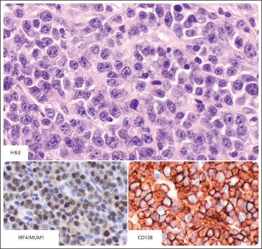 PBL of the oral cavity type in individuals infected by HIV. PBL tumor cells express markers associated with plasma cell differentiation such as CD138, CD38, and MUM1/IRF4. Tumor cells are usually negative for CD20, CD45, and CD56 (data not shown). H&E stain shows that the lymphoproliferation consists of medium-sized tumor cells displaying a cohesive pattern. Tumor cells show round nuclei with multiple nucleoli or few prominent nucleoli. The cytoplasm is generally large and basophilic. Immunostaining with the plasma cell markers MUM1/IRF4 and CD138 is strong in PBL. The pattern of staining is nuclear for IRF4/MUM1 and cytoplasmic and membranous for CD138. MUM1 and CD138, immunohistochemistry, hematoxylin counterstain. Original magnification, ×400. Images were taken using a Nikon Eclipse 80i microscope with a Plan Fluor 40×/0.75 objective and Nikon digital sight DS-Fi1 camera equipped with control unit-DS-L2. Images were processed using Adobe Photoshop 6.