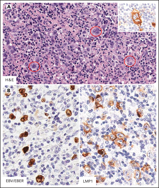 HL in individuals infected by HIV. Hodgkin and Reed-Sternberg cells (HRS) in HL of individual infected by HIV express CD15, CD30, CD40, and MUM1/IRF4 and LMP1 (EBV-type II latency) (A) Several HRS cells are seen (in the red circle) within a mixed inflammatory microenvironment. These cells express CD30 (inset). (B) EBV-infected tumor cells are demonstrated by EBER in situ hybridization and LMP1 immunostaining. CD30 and LMP1, immunohistochemistry, hematoxylin counterstain; EBER, in situ hybridization, nuclear fast red counterstaining. Original magnification, ×400. Images were taken using a Nikon Eclipse 80i microscope with a Plan Fluor 40×/0.75 objective and Nikon digital sight DS-Fi1 camera equipped with control unit-DS-L2. Images were processed using Adobe Photoshop 6.