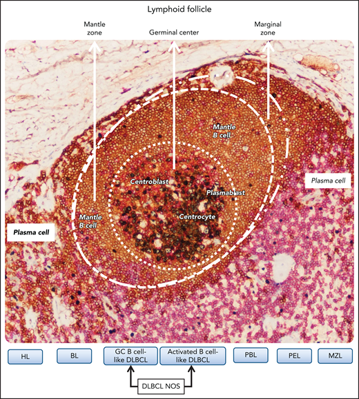 Relationship between B-cell lymphomas in individual infected by HIV and B-cell differentiation stage related to the different zones of the lymphoid follicle. B-cell lymphomas putatively develop from the malignant transformation of B cells at various stages of differentiation. The definition of cell of origin (COO) starts from the assumption that B-cell lymphomas are frozen at a given B-cell differentiation stage associated with different zones of the lymphoid follicle. The figure shows a lymphoid follicle of a reactive lymph node stained by multiplex immunostaing. In the different zones of the follicle B lymphocytes express CD20 (brown). In the germinal center (GC), B lymphocytes also express Ki67 (gray), whereas outside the marginal zone of the follicle, T lymphocytes express CD3. CD3-positive cells are also scattered in the mantle zone and in the GC. Regarding lymphomas, HL corresponds to GC B cells, and BL tumor cells correspond to centroblasts. GC B cell–like DLBCL corresponds to B cells that are arrested at various stages of the GC transits and the activated B cell-like DLBCL seems to derive from GC B cells evolving to plasma cell differentiation. PBL and PEL seem to derive from GC B cells resembling plasmablasts. Marginal zone lymphoma (MZL) corresponds to marginal zone B cells. Original magnification, ×200. Images were taken using a Nikon Eclipse 80i microscope with a Plan Fluor 20×/0.75 objective and Nikon digital sight DS-Fi1 camera equipped with control unit-DS-L2. Images were processed using Adobe Photoshop CS2 V9.0.