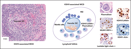 KSHV-associated MCD. KSHV-positive plasmablasts express monotypic λ light chain, IgM, CD19, and MYC; plasmablasts are also positive for CD38, CD45, and CD79a and are usually negative for CD10, CD20, CD30, CD138, BCL6, PAX5, T-cell antigens, and EBV infection (data not shown). A schematic lymphoid follicle in KSHV-associated MCD is depicted at the center. The follicle mantle zone (MZ) is typically rich in small mantle lymphocytes that are mixed with plasmablasts. These latter cells are also found at the boundary between the GC and the MZ. Vascular transformation of the GC is also depicted. Vascular GC is observed in KSHV-associated MCD as shown in the microphotograph placed on the left in the figure. As shown on the right in the figure, large cells with plasmablastic features are positive for MUM1/IRF4, λ light chain, ORF73/LANA encoded by KSHV, and viral IL6. MUM1, λ light chain, ORF73/LANA, v-IL6, immunohistochemistry, hematoxylin counterstain. Original magnification, ×200 (H&E on the left), ×1000 (H&E on the left), and ×400 (other images). Images were taken using a Nikon Eclipse 80i microscope with Plan Fluor 20×/0.75, Plan Fluor 40×/0.75, and Plan Apo/1.40 oil objectives and Nikon digital sight DS-Fi1 camera equipped with control unit-DS-L2. Images were processed using Adobe Photoshop CS2 V9.0.
