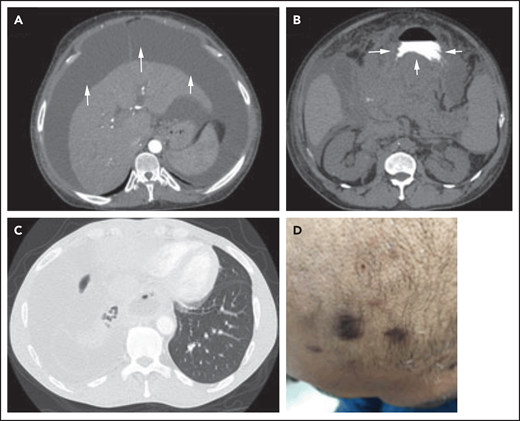Three different presentations of PEL. (A) Isolated malignant ascites in a patient with classic PEL (arrows). (B) EC/solid PEL infiltrating the stomach (arrows). Notice the mass displacing the oral contrast. (C-D) Isolated malignant right-sided pleural effusion (C) with concurrent KS (D). Notice the collapse of the right lung compared with the left (C), with characteristic purple KS lesions located on the side of the face in the same patient (D).