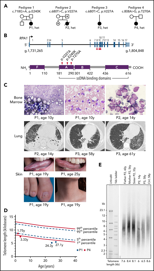 Clinical characteristics of patients with identified RPA1 variants. (A) Germline RPA1 variants identified in 4 pedigrees using exome sequencing. Black filled, open dotted, and open symbols denote affected individuals with heterozygous (het) RPA1 mutations, unaffected carriers, and unaffected family members without mutations, respectively. (B) Top panel: schematic of the RPA1 gene with 17 coding exons illustrated as black lines and untranslated regions shown in red (NM_002945.5). The 3 unique patient variants are located on exons 8, 9, and 10. Bottom panel: Human RPA1 protein illustration with 4 oligonucleotide/oligosaccharide–binding fold domains F, A, B, and C with amino acid boundaries shown below. Oligonucleotide/oligosaccharide–binding folds A, B, and C are ssDNA-binding domains. Red arrows indicate location of 3 RPA1 missense alterations. (C) BM findings in patient cohort (top panel): P1 BM aspirate smears (Wright-Giemsa staining) at time of clinical presentation at age 10 years showing marked reduction in cell content with hypoplasia of all lineages (left image) and megaloblastic maturation of erythroid precursors (middle image). P2 BM infiltrated with myeloblasts (right image) consistent with MDS with excess blasts. Pulmonary findings by chest computed tomography (CT) imaging in patient cohort (middle panel): P2 chest CT scan (left image) during hospitalization showing necrotizing pneumonitis with diffuse ground-glass opacities and large air-filled cavities with differential diagnosis, including pulmonary GVHD, opportunistic infection(s), pulmonary fibrosis, or a combination of the aforementioned conditions. P3 presented at age 58 years with cough and exertional dyspnea with chest CT scan (middle image) findings showing intralobular reticulations with traction bronchiectasis and mild honeycombing, with left asymmetric and basal, subpleural predominance. At 61 years, P3 chest CT scan (right image) showed significant progression of asymmetric lung fibrosis with left predominance and massive basal honeycombing. Mucocutaneous abnormalities in P1 (bottom panel): oral leukoplakia at 19 years of age (top left image) with mild improvement at 25 years of age (top right image), nail dystrophy (bottom left image), and reticular skin pigmentation on the ventral neck (bottom right image). (D) Telomere length analysis by flow cytometry–based FISH was conducted in lymphocytes of P1 (red circles) and P4 (blue circles). P1 telomere length is less than the first percentile at 24 and 27 years of age (red circles). P4 telomere length is at the fifth percentile at 1.75 years of age and less than the first percentile at age 3.33 years (blue circles). All measurements were performed in triplicate, and mean telomere length was calculated in kilobases in relation to the internal control (bovine thymocytes) with known telomere length. A total of 356 healthy controls used for calculation of the first (solid line, bottom), fifth (dashed line, bottom), 95th (dashed line, top), and 99th (solid line, top) percentile curves. (E) TRF analysis in peripheral blood DNA from P2 and family and P3 compared with healthy age–matched control (Ctrl), digested with HinfI and RsaI enzymes followed by separation on 0.7% agarose gel.