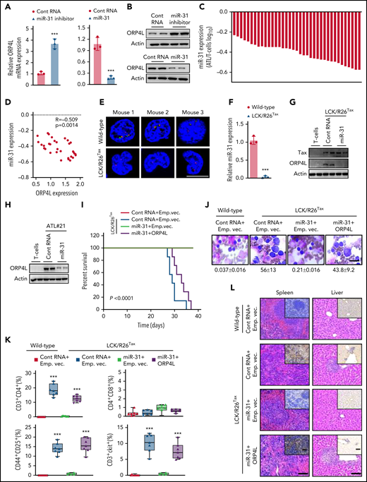 Tax triggers ORP4L expression and T-cell malignant transformation via suppression of miR-31. (A-B) qPCR (A) and western blot (B) analyses confirming the effects of miR-31 inhibitor on ORP4L expression in HeLa cells and the effects of miR-31 mimic on ORP4L expression in MT-4 cells. Mean ± standard deviation (SD; n = 3 experimental repeat; Student t test). (C) qPCR analysis of miR-31 expression in T cells of patients with ATL (n = 37), as compared with normal T cells (n = 5). (D) Pearson’s correlation coefficient of miR-31 and ORP4L expression within human ATL specimens (n = 37). (E) Multicolor fluorescence in situ hybridization analysis of the genomic status of miR-31 encoding (green probe) and its host gene (origin probe) regions in T cells of 2-month-old WT and LCK/R26Tax mice. The chromosome 4 centromere (red probe) is included as a control. Scale bar, 5 μm. (F) miR-31 expression in 2-month-old WT and LCK/R26Tax mouse T cells analyzed by qPCR. Mean ± SD (n = 3 mice of each group; Student t test). (G) Western blot analysis of the expression of ORP4L in LCK/R26Tax T cells or LCK/R26Tax T cells overexpressing miR-31. The cells were isolated and infected with lentivirus carrying control RNA or miR-31 and cultured for 96 hours in vitro. (H) Western blot analysis of the expression of ORP4L in human normal T cells or human ATL T cells overexpressing miR-31. The cells were isolated and infected with lentivirus carrying control RNA or miR-31 and cultured for 96 hours in vitro. (I) Kaplan-Meier comparative survival analysis of B-NDG mouse recipients of WT T cells or LCK/R26Tax T cells overexpressing miR-31 or overexpressing both miR-31 and ORP4L. The LCK/R26Tax T cells were coinfected with the lentivirus carrying control RNA miR-31, empty vector (Emp.vec.), or ORP4L as follows: control RNA+Emp.vec., miR-31+Emp.vec., miR-31+ORP4L, and cultured for 96 hours in vitro before transplantation (n = 7; mice of each group, log-rank test). (J) Representative images of peripheral blood smears from B-NDG mice treated as in panel I. The number of abnormal lymphocytes on smears in each cohort are indicated below the images. Scale bar, 10 μm. (K) The percentage of CD3+CD4+, CD4+CD8+, CD44+CD25+, and CD3+c-Kit+ cells in peripheral blood of B-NDG mice treated as in panel I. Mean ± SD (n = 7 mice of each group; Student t test). (L) Representative histologic hematoxylin and eosin– and anti-CD3–stained sections showing T-cell infiltration in spleen and liver of B-NDG mice treated as in panel I. Scale bars, 100 μm. (M) Kaplan-Meier comparative survival analysis of B-NDG mouse recipients of T cells of patients with ATL (ATL#21). The cells were isolated and coinfected with lentivirus carrying control RNA, miR-31, Emp.vec. or ORP4L as follows: control RNA+Emp.vec., miR-31+Emp.vec., control RNA+ORP4L, and miR-31+ORP4L and cultured for 96 hours in vitro before transplantation (n = 8 mice each group, log-rank test). (N) The percentage of human CD45+CD3+ ATL T cells in peripheral blood of B-NDG mice treated as in panel M. Mean ± SD (n = 8 mice in each group; Student t test). ***P < .001.