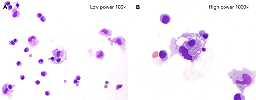 The patient is a 66-year-old woman with chemorefractory diffuse large B-cell lymphoma who received axicabtagene ciloleucel anti-CD19 chimeric antigen receptor (CAR) T-cell therapy. On day +1 after CAR infusion she developed a fever consistent with grade 1 cytokine release syndrome (CRS). She received 2 doses of tocilizumab, 8 mg/kg, on days +6 and +7 for persistent CRS. On day +8 she developed word finding difficulty and started IV dexamethasone, 10 mg every 6 hours. On day +9 she progressed with grade 2 ICANS (immune effector cell–associated neurotoxicity syndrome). Brain magnetic resonance imaging was unrevealing. Lumbar puncture with cerebrospinal fluid (CSF) analysis revealed an elevated white blood cell count (39/μL) without evidence of lymphoma. Immunophenotypic analysis demonstrated 55% T cells and no B cells. Wright-stained CSF cytospin revealed many hemophagocytic histiocytes (panel A, original magnification ×100; panel B, ×1000) consistent with a dysregulated immune response after CAR T-cell therapy. She received intrathecal hydrocortisone, 100 mg, with improvement. On day +13 she had recurrent grade 3 ICANS and received intrathecal hydrocortisone+methotrexate+cytarabine with full neurological recovery by day +14. Peak levels of ferritin, C-reactive protein, and lactate dehydrogenase in the first 28 days were 387 ng/mL, 14.93 mg/dL, and 287 U/L, respectively. She achieved remission and remains relapse free at 4 months posttreatment.