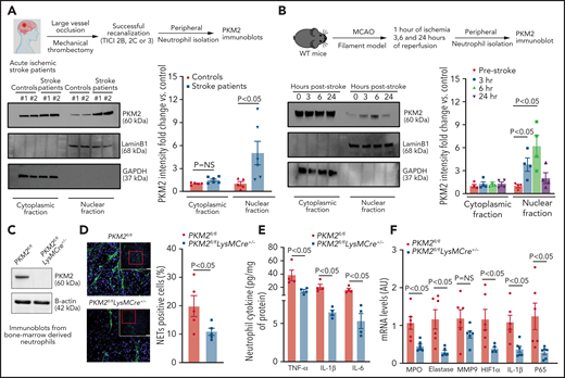 Nuclear PKM2 is elevated in peripheral neutrophils after a stroke in humans and in WT mice and regulates neutrophil hyperactivation. (A) Top: schematic of experimental design. Bottom: western blot analysis of PKM2 in the cytosolic and nuclear fraction from the peripheral neutrophils isolated from the patients with acute ischemic stroke who underwent successful mechanical thrombectomy. The quantitative data for cytosolic and nuclear PKM2 intensity (normalized to the intensity of lamin-B1/glyceraldehyde-3-phosphate dehydrogenase (GAPDH) are shown on the right. (B) Top: schematic of experimental design. Bottom: western blot analysis of PKM2 in the cytosolic and nuclear fraction from the peripheral neutrophils of male WT mice. The quantitative data for cytosolic and nuclear PKM2 intensity (normalized to the intensity of lamin-B1/GAPDH at each time point) are shown on the right. (C) Western blot analysis of PKM2 from neutrophils derived from the bone marrow of male mice. (D) Immunofluorescence analysis of NETs from peripheral neutrophils isolated 6 hours after reperfusion. Neutrophils were stimulated with a suboptimal concentration of PMA (10 ng/mL), and NETs were visualized by using SYTOX Green stain. Scale bars, 100 µm. Quantification is shown on the right. (E) Inflammatory cytokines in peripheral neutrophils isolated 6 hours after reperfusion from each group as analyzed by enzyme-linked immunosorbent assay (ELISA). (F) Gene expression analysis for the neutrophils isolated 6 hours after reperfusion as analyzed by reverse transcriptase polymerase chain reaction. Data are from 2-way repeated measures analysis of variance (ANOVA) (Kruskal-Wallis test) followed by Fisher’s least significant difference (LSD) test; panels (A-B); or an unpaired Student t test (D-F). Data are mean ± standard error of the mean (SEM); n = 4-6 (A-B); n = 4-5 (D-E); n = 6 (F). AU, arbitrary units; HIF1-α, hypoxia-inducible factor 1-α; MCAO, middle cerebral artery occlusion; MMP9, matrix metallopeptidase 9; mRNA, messenger RNA; NS, not significant; TICI, thrombolysis in cerebral infarction.