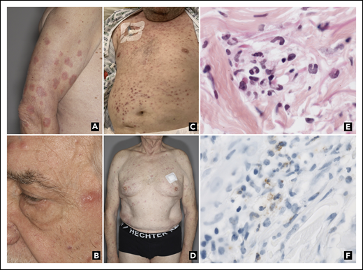 Clinical and pathological pictures of myelodysplasia cutis. (A) Arm annular edematous, erythematous (inflammatory) plaques (SS-like) in patient number 1. (B) Forehead edematous, erythematous (inflammatory) papules (SS-like) in patient number 7. (C) Dark red diffuse papulo-nodules (leukemia cutis–like) in patient number 2. (D) Pink red diffuses papulo-nodules (leukemia cutis–like) in patient number 4. (E) Inflammatory infiltrate consisting of myeloid cells with indented nuclei corresponding to metamyelocytes or band neutrophils, with some of them carrying pseudo–Pelger-Huet abnormality (hematoxylin-eosin-saffron, original magnification ×1000). (F) Myeloid cells expressed myeloperoxidase (immunostaining, ×1000).