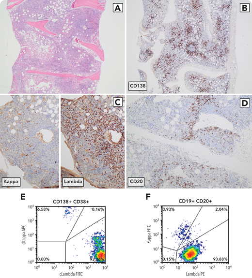 A 63-year-old woman with a history of JAK-2–negative polycythemia (peak hemoglobin, 20.2 g/dL; white blood cells, 8.8 × 109/L; platelets, 346 × 109/L) and elevated erythropoietin (peak value, 2265 U/L) presented with hypoxemic dyspnea and a calculated shunt fraction of 16.7%. She had a known immunoglobulin M (IgM) λ monoclonal gammopathy (12.8 g/L), chronic telangiectasias, and bilateral perinephric fluid collection. A diagnosis of telangiectasias, elevated erythropoietin and erythrocytosis, monoclonal gammopathy, perinephric fluid collection, and intrapulmonary shunting (TEMPI) syndrome was made. A bone marrow biopsy demonstrated hypercellular marrow with erythroid hyperplasia (panel A; original magnification ×40; hematoxylin and eosin stain). Ancillary studies uncovered 2 neoplastic cell populations including a λ-restricted plasma cell population lacking CD56/cyclin D1/PAX5 expression that consisted of 15% marrow cells (panel B; original magnification ×40; CD138 immunostain; panel C; original magnification ×100; κ and λ immunostains; panel E; flow cytometry). The second population was made up of λ-restricted CD5/CD10-negative B cells consisting of 5% marrow cells (panel D; original magnification ×100; CD20 immunostain; panel F; flow cytometry). The identification of a MYD88 L265P mutation supported the histologic impression of a lymphoplasmacytic lymphoma. The patient responded to cyclophosphamide, bortezomib and dexamethasone (CyBorD) chemotherapy before relapsing 1.5 years later.