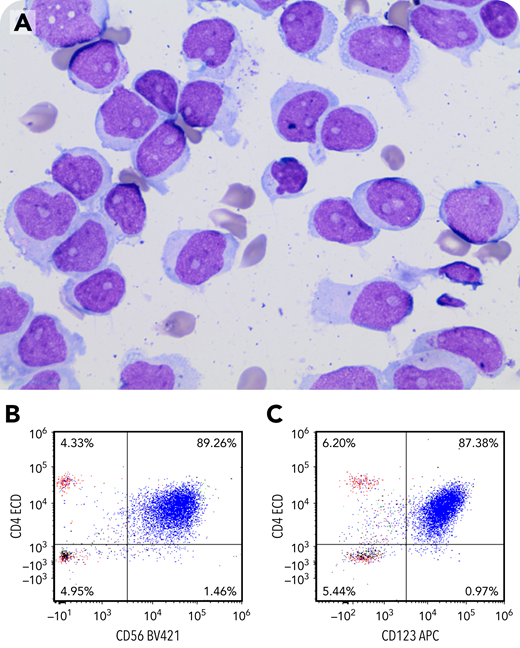 A 32-year-old man presented with fever, generalized bone pain, and pancytopenia. Bone marrow was diagnostic of blastic plasmacytoid dendritic cell neoplasm (BPDCN). Treatment with hyper-CVAD was initiated, and he attained a complete remission. He declined lumbar punctures (LPs) during the course of initial treatment. Prior to transplant, a bone marrow biopsy showed no evidence of residual BPCDN. Positron emission tomography/computed tomography scan results were normal. During his visit, he reported temporal headaches bilaterally. His pain progressed over several days, prompting brain magnetic resonance imaging, which was normal. An LP revealed a white blood cell count of 3081/uL, 80% of which were blasts that showed irregular nuclear contours, dispersed nuclear chromatin, prominent nucleoli, and moderate amount of cytoplasm (panel A, ×100 objective, ×1000 total magnification). Flow cytometry showed a blast population expressing CD4, bright CD56 (panel B), and bright CD123 (panel C), constituting approximately 87% of analyzed cells. The patient was diagnosed with central nervous system (CNS) BPDCN and was started on twice-weekly intrathecal methotrexate.