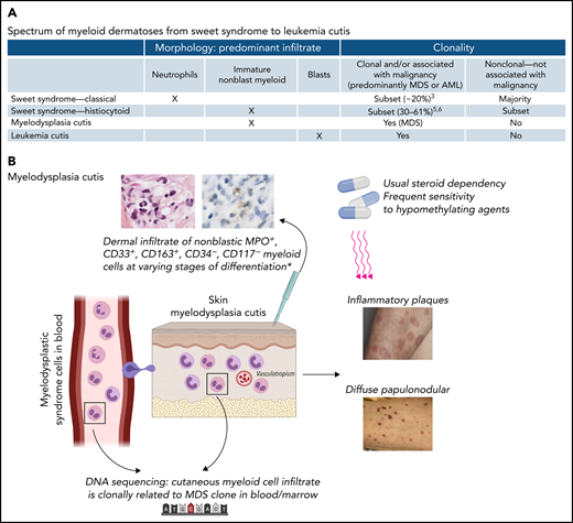 (A) Spectrum of myeloid dermatoses, including classical Sweet syndrome, histiocytoid Sweet syndrome, the proposed entity of MDS cutis, and leukemia cutis. The morphology of the predominant skin infiltrate in each entity is indicated. The clonality or association of each entity with malignancy is also shown. The most common malignancies are myeloid malignancies. (B) MDS cutis. MDS cells originating in the bone marrow circulate in the peripheral blood, entering the skin and forming a dermal infiltrate with histologic features of so-called histiocytoid Sweet syndrome. On skin biopsy, the infiltrate is MPO+, CD33+, CD163+, MPO+, CD34−, and CD117−. This immunophenotype represents nonblast myeloid precursors at varying stages of differentiation and myelomonocytic cells. DNA sequencing of bone marrow and skin identify the presence of the same mutations, providing evidence that the cutaneous myeloid cells are clonally related to the MDS cells in the marrow. MDS cutis may present as inflammatory plaques or diffuse papulonodular lesions. Lesions may respond to steroids with dependency, although there is frequent response to hypomethylating agents in this study.