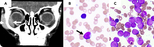 A four-year-old girl presented with an asymptomatic unilateral orbital swelling with no other abnormal physical findings. Her pediatrician obtained an MRI and referred her to ophthalmology to biopsy an orbital mass seen on MRI (panel A, arrow). Complete blood count (CBC) prior to biopsy showed anemia (Hgb 7.9 g/dL), thrombocytopenia (platelets 68 000 per µL), white blood cell count 5500 per μL, with 25% blasts (panel B, peripheral smear showing blast, arrow, and nearby lymphocyte, Wright-Giemsa stain (WG), original magnification ×1000). Peripheral blasts had lymphoblastic morphology and were positive by peripheral blood (PB) flow cytometry for CD10, CD19, CD22, TdT, and negative for light chains. Based on these findings, the diagnosis of B-acute lymphoblastic leukemia (B-ALL) was made, and the biopsy was canceled. Bone marrow aspiration showed sheets of blasts (panel C; 85.7%, WG, original magnification ×1000).