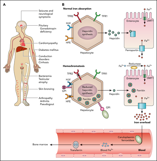 PIGA mutations (can) cause juvenile hemochromatosis. Hemochromatosis is the most frequent iron overload disorder in humans. (A) The clinical symptoms that can be provoked by iron overload. Affected organs are typically the pituitary gland, the heart, the liver, pancreas, testes, and the joints. Newly reported in the current paper are neurologic symptoms. (B) Normal iron absorption is depicted in the upper panel. Signaling downstream of HFE, HJV, and TFR2 induce the expression of the iron regulatory hormone hepcidin (green dots). Hepcidin is synthesized by hepatocytes and binds to and inactivates the iron exporter ferroportin (blue channel). Iron (Fe2+, red dots) is incorporated into the enterocyte via DMT1 (green channel) and exported via ferroportin into the blood. Soluble ceruloplasmin oxidizes Fe2+ to Fe3+, which, in turn, is bound to transferrin and transported to the bone marrow for erythropoiesis. Typically, hemochromatosis develops owing to mutations in the hemochromatosis gene, HFE (B lower panel), HJV, TFR2, hepcidin, or ferroportin.2 Either reduced hepcidin synthesis is caused by one of these mutations or a mutation in ferroportin leads to excessive iron accumulation. Mutations in HJV or hepcidin cause the most severe form of iron overload, juvenile hemochromatosis. HJV and membrane-bound ceruloplasmin are GPI-linked proteins, as shown in the lower panel. The authors of the current paper identified mutations in phosphatidylinositol glycan anchor biosynthesis class A (PIGA), an enzyme involved in GPI-anchor biosynthesis in 3 patients with clinical symptoms of hemochromatosis and neurologic symptoms. TRF1, transferrin receptor 1. Professional illustration by Patrick Lane, ScEYEnce Studios.