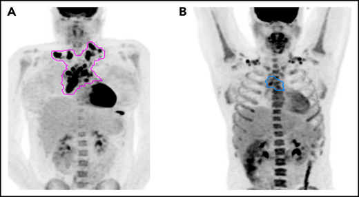 Pattern of relapse definitions. (A) Theoretical outline (pink) of initial site of disease based on the prechemotherapy PET/CT scan. A relapse within the outlined region would have been categorized as a relapse in the “initial site” of disease. A relapse outside of the outlined region would be considered a “new site” of relapse. (B) Theoretical outline (blue) of fluorodeoxyglucose-avid residual disease greater than the mediastinal blood pool on PET/CT after 1 cycle of AVPC. For PET1+ patients, a relapse within the blue region would be considered a relapse at the “PET1+ site,” whereas a relapse outside of the blue region but within the pink region from panel A would be considered “initial site beyond the PET1+ site.”