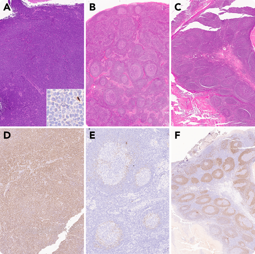 A 53-year-old woman presented with a mass at the base of her tongue. Biopsies of the lesion demonstrated diffuse effacement of the submucosal tissue by intermediate-sized lymphocytes with atypical centrocytic morphology (A). These lymphocytes were CD20+ and CD5+ B cells that were negative for CCND1 (cyclin D1) (A inset). The lymphocytes were diffusely positive for SOX11 (D) and diagnostic of CCND1− mantle cell lymphoma. Fluorescence in situ hybridization confirmed the absence of CCND1 rearrangement. The patient had undergone a right neck lymph node biopsy and bilateral tonsillectomy 9 and 5 years previously, respectively, both with benign diagnoses. These specimens were reevaluated given the patient’s new lymphoma diagnosis. The initial lymph node biopsy demonstrated reactive morphologic features including follicular hyperplasia and dermatopathic changes (B). SOX11+ lymphocytes were present, restricted to the inner mantle zones (E). The subsequent tonsil biopsy demonstrated a subtle expansion of the mantle zones (C) by numerous SOX11+ cells (F).